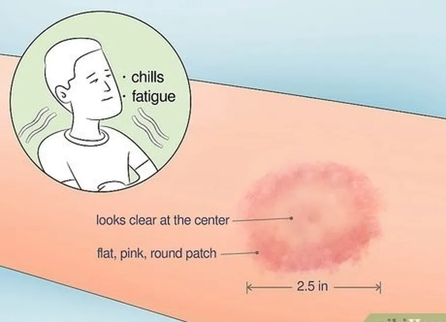 Etapa 2 Fique atento aos sintomas da doença de Lyme ou de uma infecção grave.