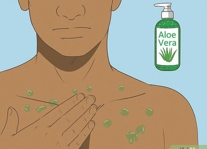 A aloe vera acalma e hidrata a pele inflamada.