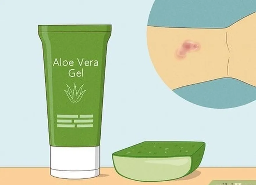 Etapa 7 Aplique aloe vera na erupção cutânea para ajudar a aliviar a coceira.