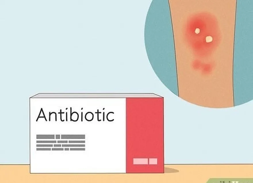 Etapa 3 Tome um antibiótico prescrito no caso de uma infecção.