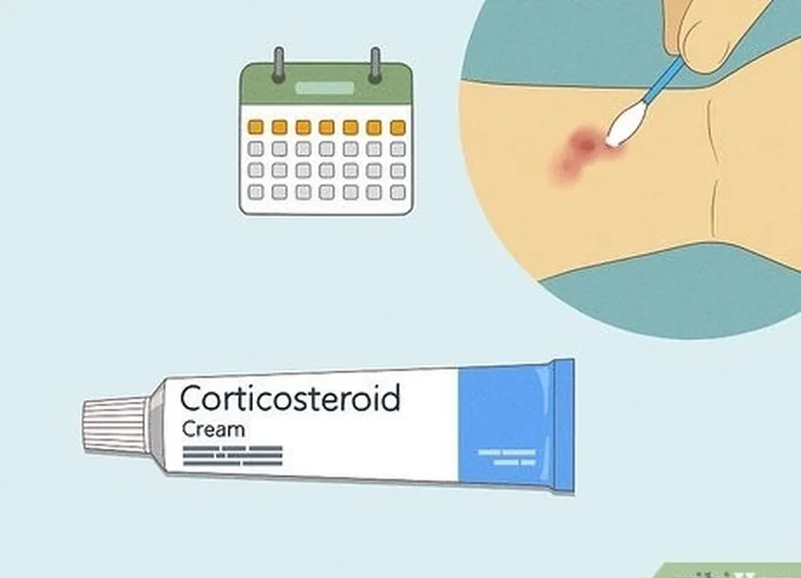 Etapa 1 Use um creme corticosteroide de venda livre por até uma semana.