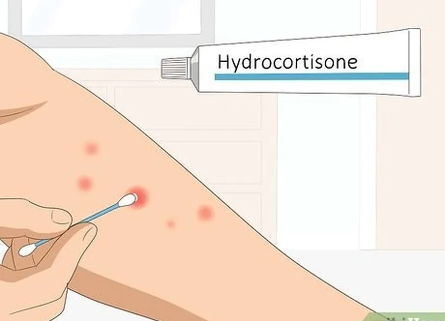 Passo 2 Experimente um creme de hidrocortisona ou anti-histamínico de venda livre.