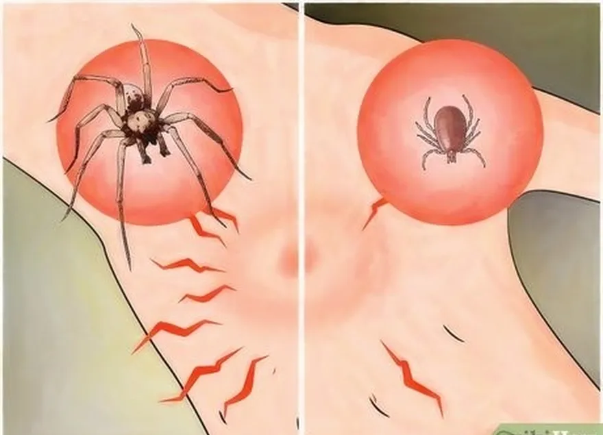 Etapa 3: Não't confuse tick bites as spider bites.