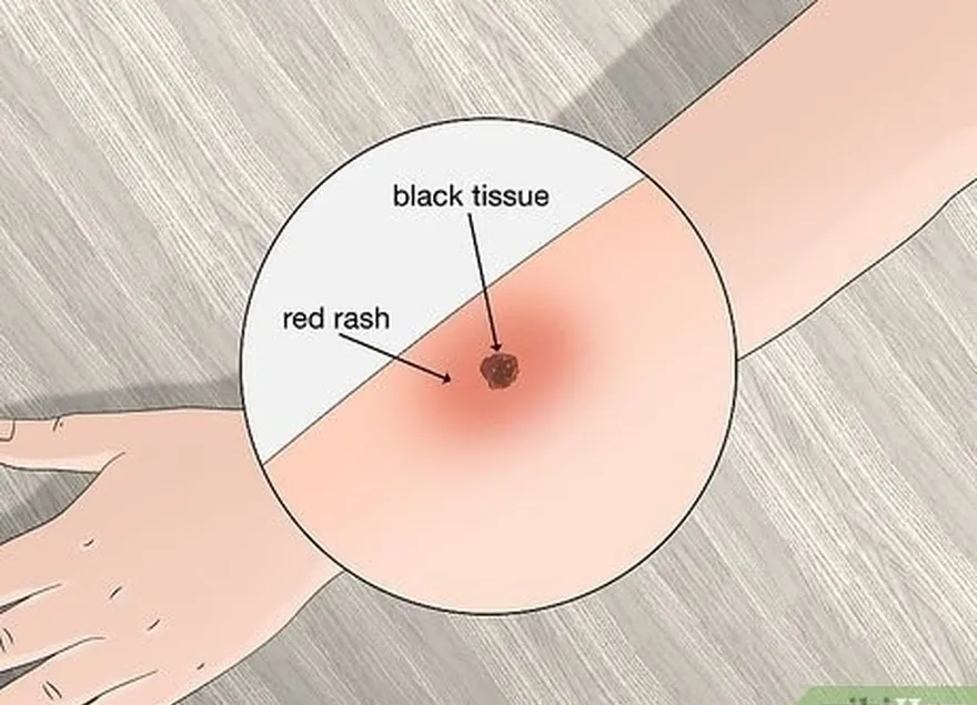 Passo 2 Procure uma erupção cutânea vermelha e tecido preto à volta do local da picada da carraça.