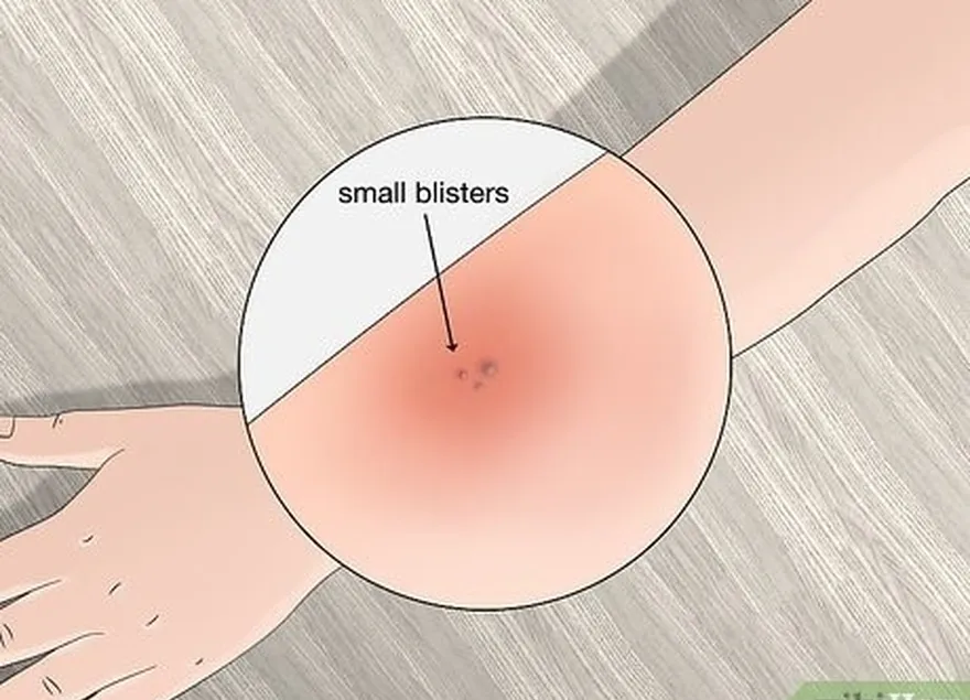 Passo 4 Suspeitar da doença de Lyme se aparecerem pequenas bolhas à volta da picada da carraça.