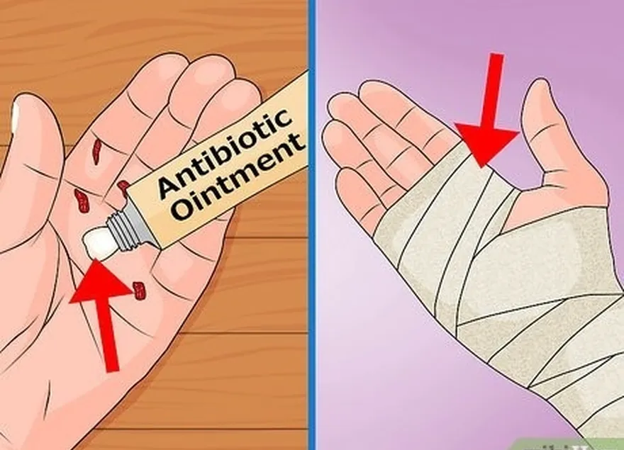 Etapa 10 Aplique pomada antibiótica nas feridas.