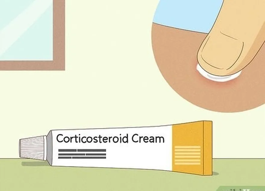 Etapa 1 Aplique um creme anti-histamínico ou corticosteroide em sua pele.